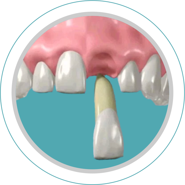 Fixação de elemento dentário.